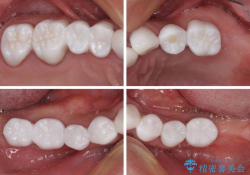 欠損と虫歯だらけの口の中 真っ白なセラミック治療の治療後