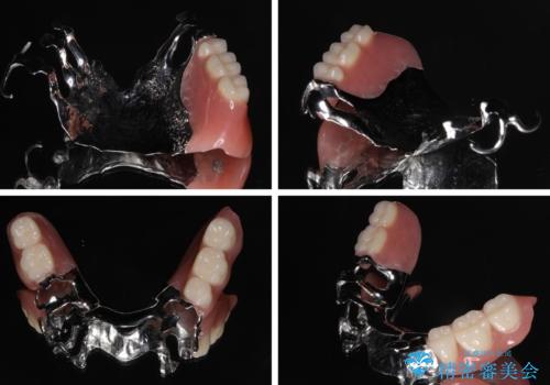 装着感の良い入れ歯を作りたい 金属床を使用した適合の良い部分床義歯の治療後