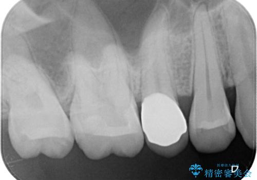 【セラミックインレー】定期検診にて虫歯を発見の治療後