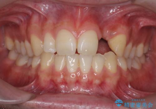 前歯部 インプラント治療の治療前