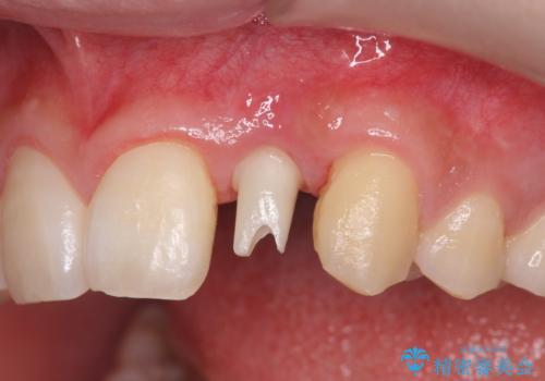 前歯部 インプラント治療の治療中