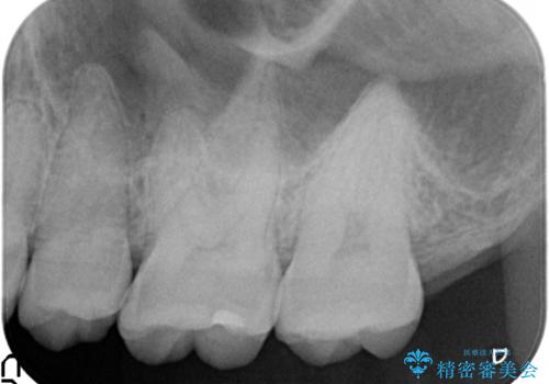 虫歯の再発リスクを減らすセラミックインレーの治療前
