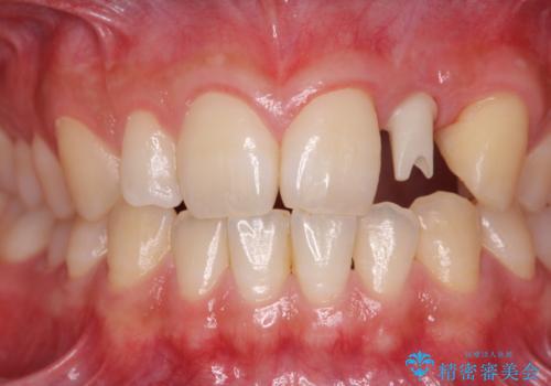 前歯部 インプラント治療の治療中