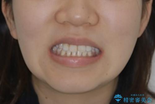 インビザライン単独での抜歯矯正治療の治療後（顔貌）