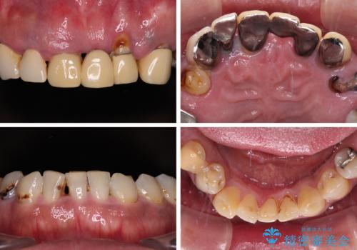 欠損と虫歯だらけの口の中 真っ白なセラミック治療の治療前