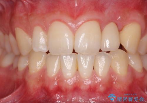 前歯部 インプラント治療の治療後
