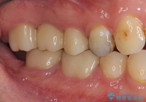 「 セラミック治療 」奥歯を白くしたいの症例 治療後