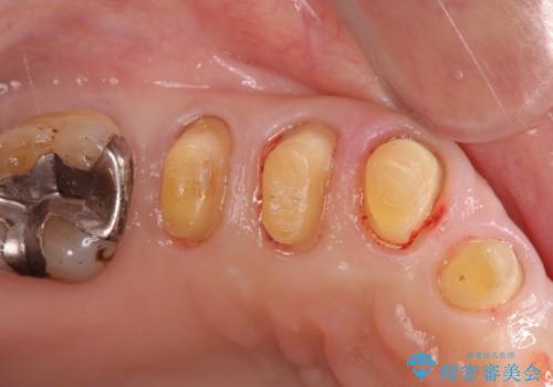 歯周病に対する全体治療の治療中