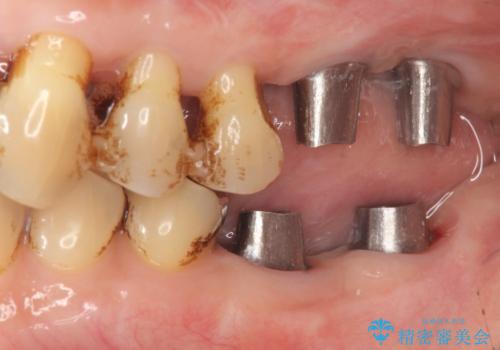 歯周病に対する全体治療の治療中
