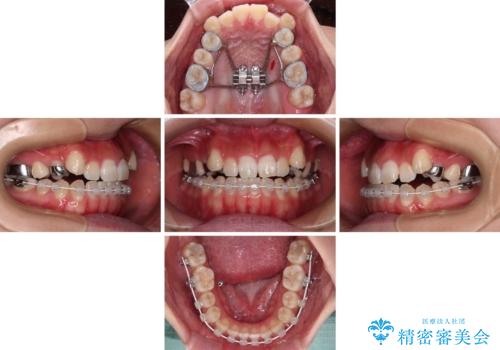 【モニター】上顎が狭い 急速拡大装置を用いたデコボコの解消の治療中
