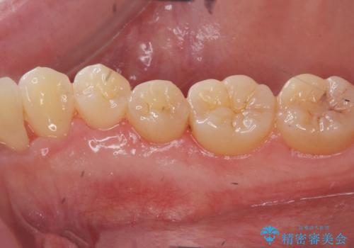 マウスピース矯正前に行う骨隆起の除去の治療後
