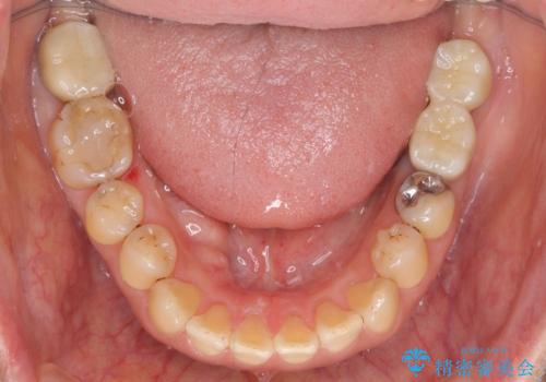 歯周病に対する全体治療の治療後