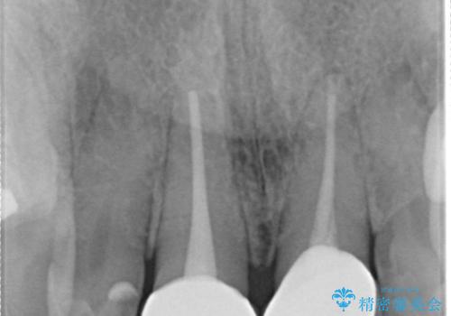 前歯の着色が気になる(失活歯)の治療後