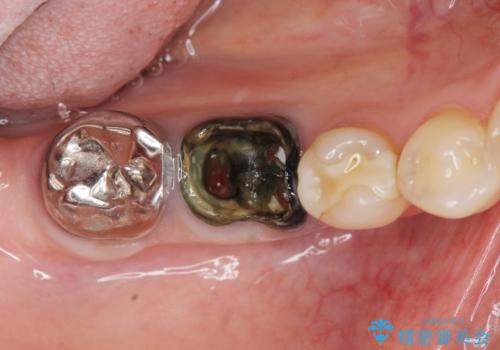 銀歯の下に大きな虫歯の再発の治療前