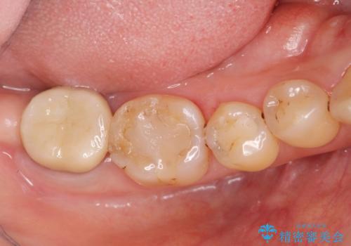 歯周病に対する全体治療の治療後