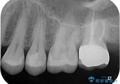 【セラミックインレー】虫歯の治療の治療後