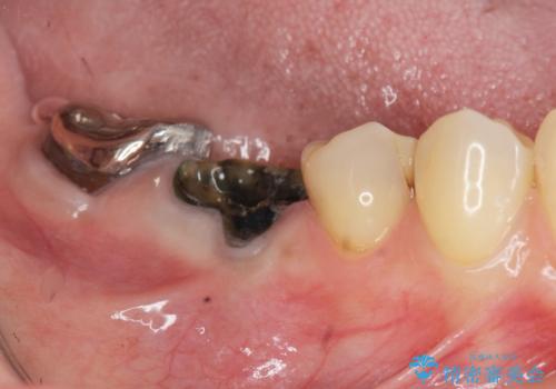 銀歯の下に大きな虫歯の再発の症例 治療前