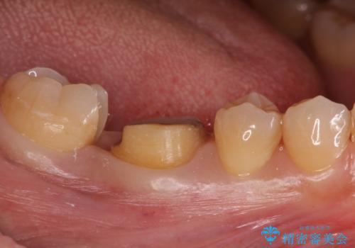 銀歯が取れた セラミックでのやり替えの治療中