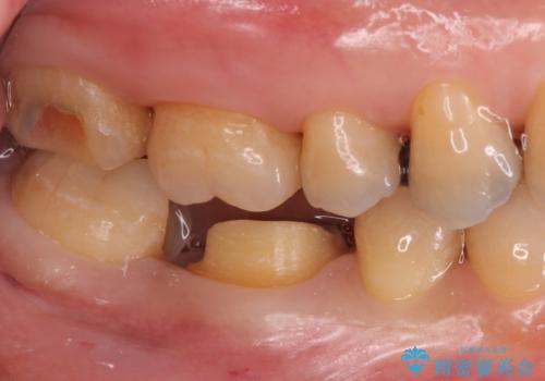 銀歯が取れた セラミックでのやり替えの治療中