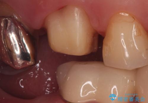 割れた被せ物を作りなおしたいの治療中