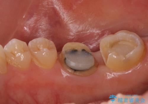 銀歯が取れた セラミックでのやり替えの治療中