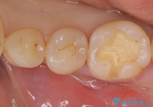 奥歯の詰め物をやり替えたい　セラミックインレーでの治療の治療中