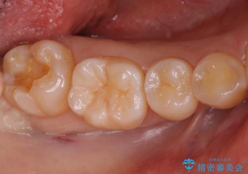 奥歯の深い黒ずみ　セラミックインレーでの治療の治療中