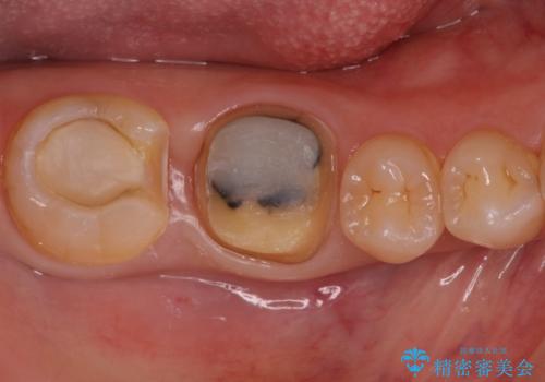 銀歯が取れた セラミックでのやり替えの治療中