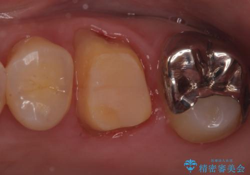 割れた被せ物を作りなおしたいの治療中