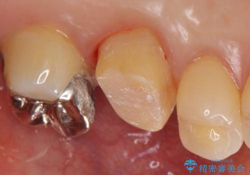 割れた被せ物を作りなおしたいの治療中