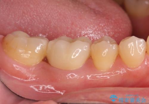 銀歯が取れた セラミックでのやり替えの治療後