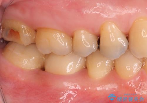 銀歯が取れた セラミックでのやり替えの治療後