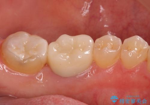 銀歯が取れた セラミックでのやり替えの治療後
