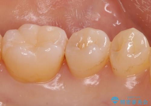 奥歯の詰め物をやり替えたい　セラミックインレーでの治療の治療後