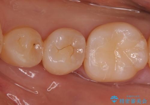 奥歯の詰め物をやり替えたい　セラミックインレーでの治療の症例 治療後