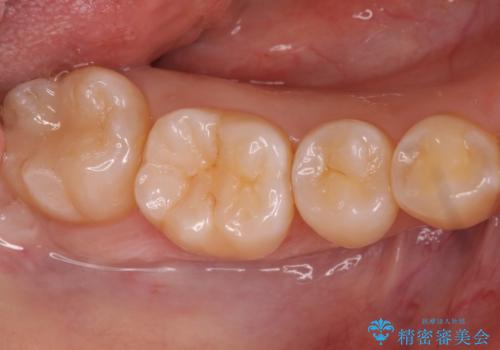 奥歯の深い黒ずみ　セラミックインレーでの治療の症例 治療後