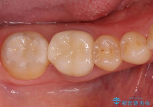 銀歯が取れた セラミックでのやり替えの治療後