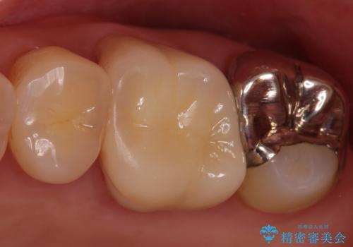 割れた被せ物を作りなおしたいの治療後