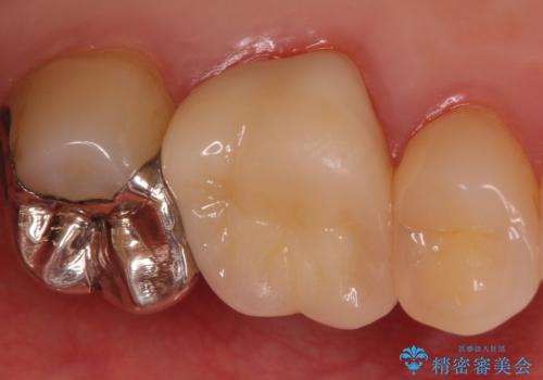 割れた被せ物を作りなおしたいの治療後