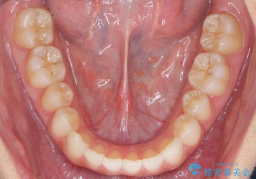 前歯が出っ歯ですきっ歯　抜かずに前歯を見た目良くの治療後