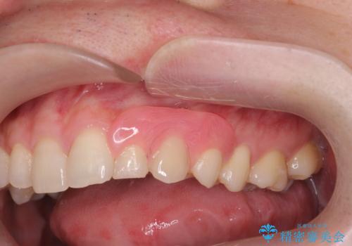前歯に目立たないノンクラスプデンチャーを作りたいの治療後