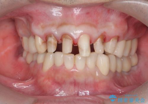 全ての歯を治療したいの治療中