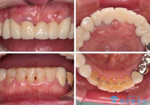 前歯をきれいにしたい インプラントや部分矯正を用いた総合歯科治療の治療後