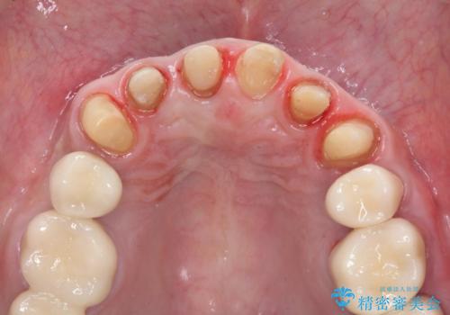 全ての歯を治療したいの治療中