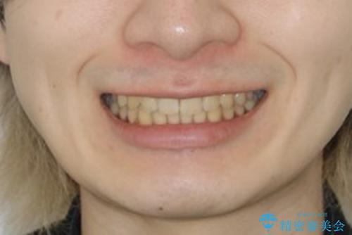 インビザライン:前歯のがたつきと噛み合わせの治療の治療後（顔貌）