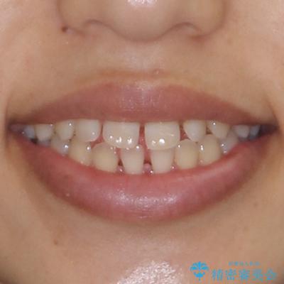 隙間だらけの歯列　インビザラインで改善の治療前（顔貌）