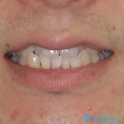 前歯のクロスバイト　目立たないワイヤー装置で矯正治療の治療前（顔貌）