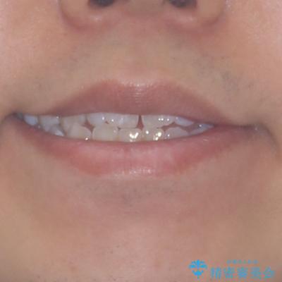 口元の突出感を改善　受け口傾向の咬み合わせの抜歯矯正の治療前（顔貌）