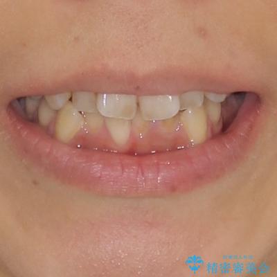 デコボコと口元の突出感 ハーフリンガルでの抜歯矯正の治療前(顔貌)