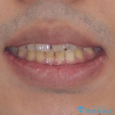 後戻りでデコボコの前歯 インビザライン矯正治療の治療前(顔貌)